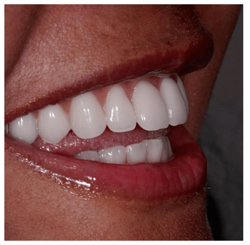 Implantes Dentários em Itapetininga - Odonto Centro Lotfi